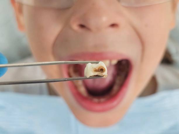 Best Emergency Treatment for Oral Infections in Millington, TN